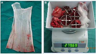Forgotten joint score associated with prosthesis weight in cementless total hip arthroplasty: a prospective clinical study